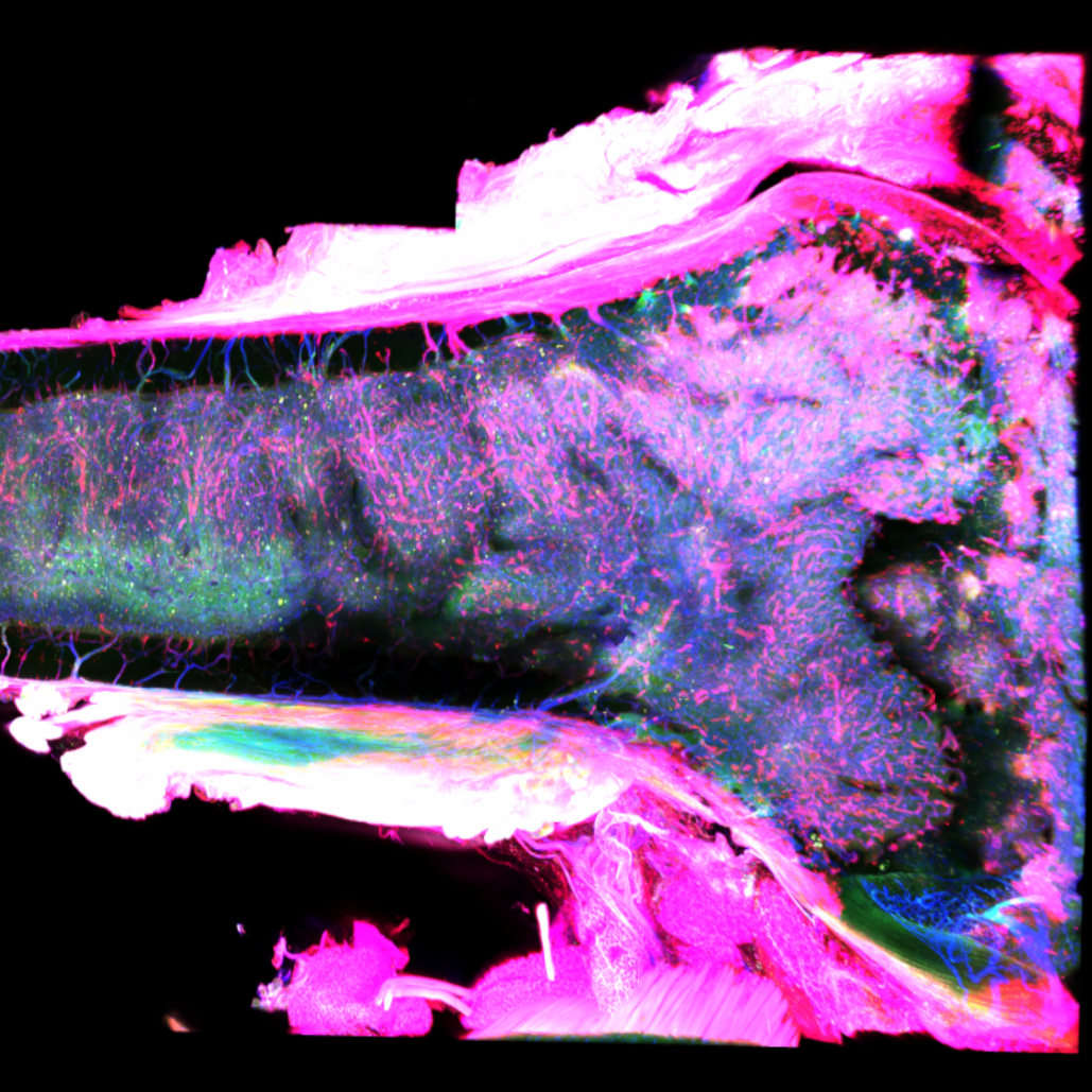 Spatial Relationships Within Bone Tumor Microenvironment