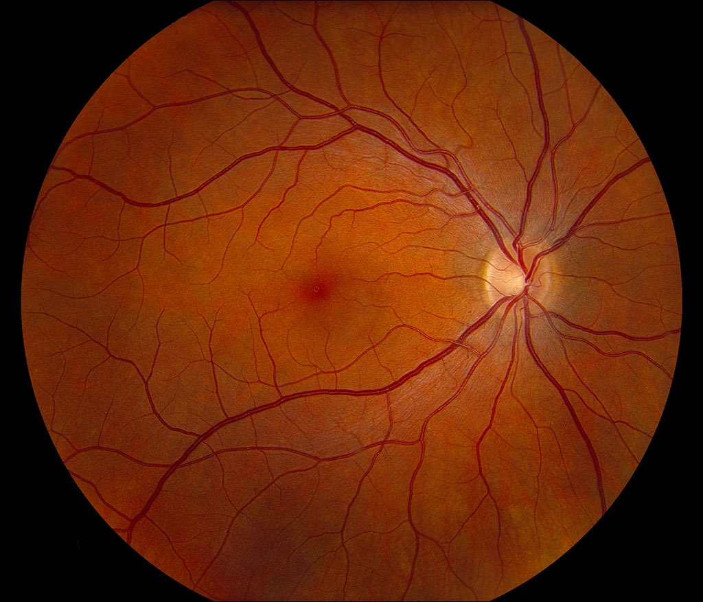 Deep-learning models for the detection and incidence prediction of chronic kidney disease and type 2 diabetes from retinal fundus images