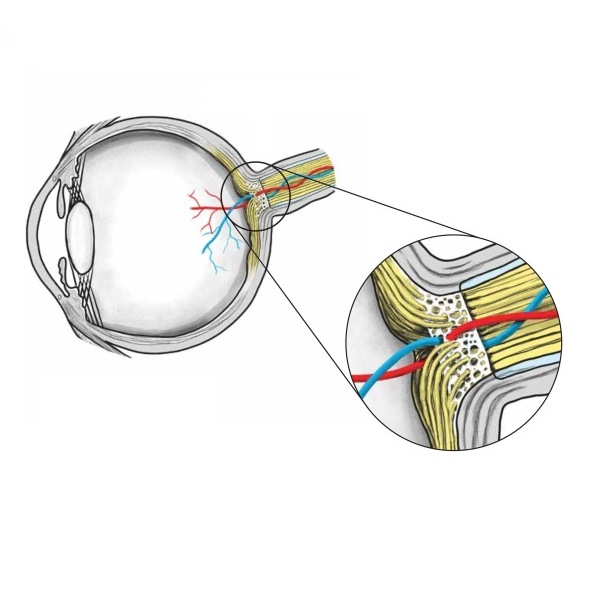 Systemic Antihypertensive Use Increases the Incidence of Glaucoma Progression